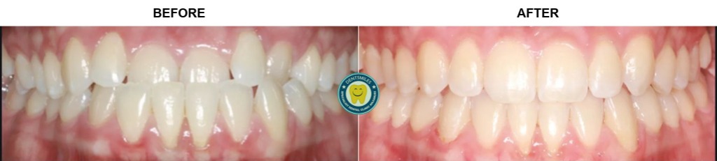 Smile Transformation Case 1