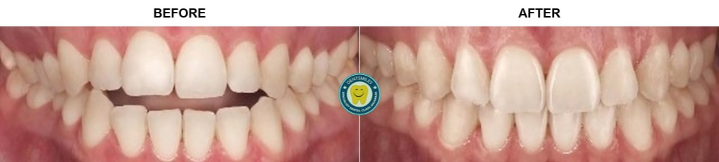 Smile Transformation Case 2