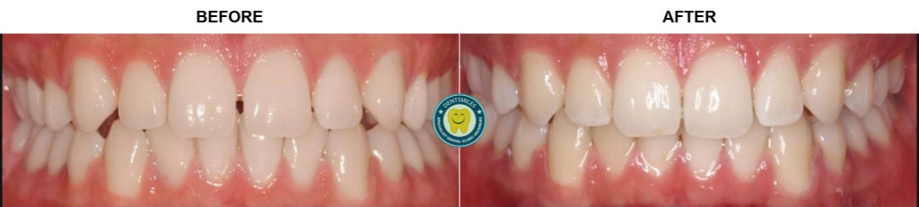 Smile Transformation Case 3