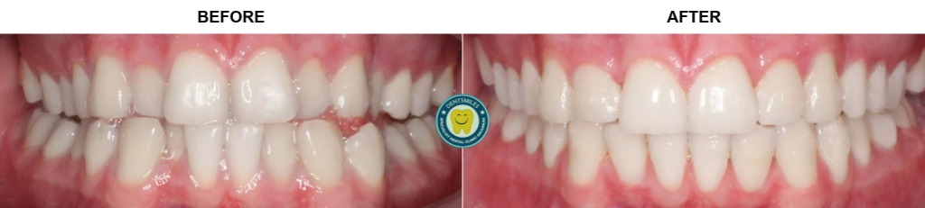 Smile Transformation Case 4