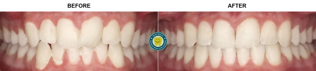 Smile Transformation Case 5