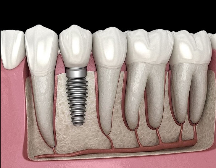 Implantology